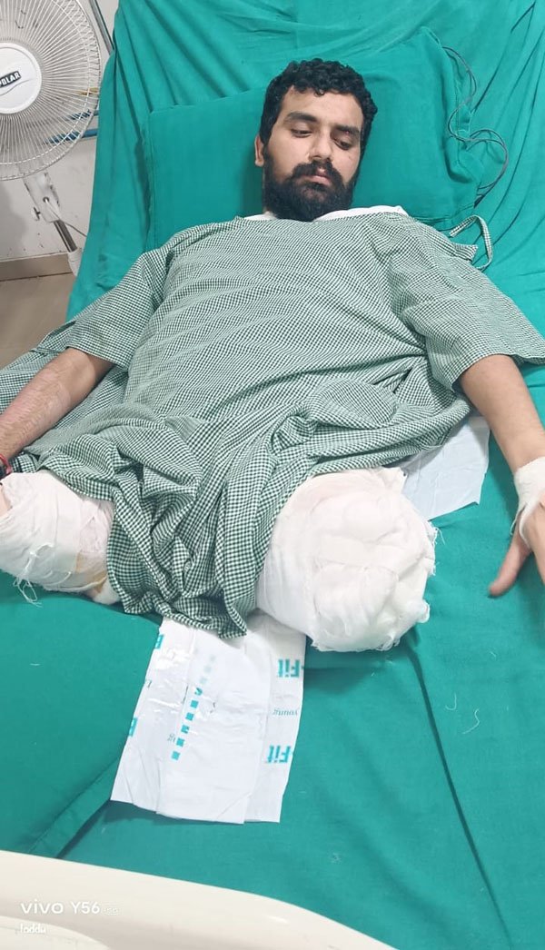(रायपुर) दुर्घटना में कट गये थे दोनों पांव, फिर भी बचा ली जान