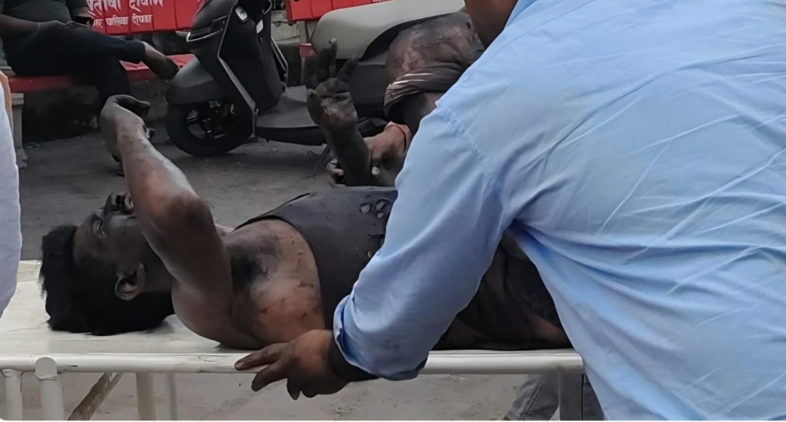(कोरबा ) एसईसीएल में हुई लापरवाही, मजदूर के दोनो हाथ कटे 