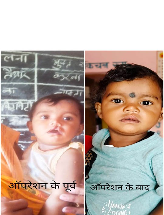 (रायपुर) चिरायु दल ने लौटाई मासूम रंजना की मुस्कान