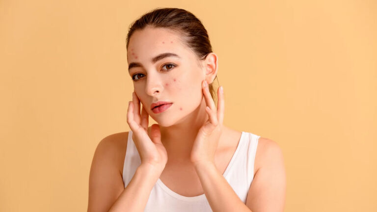 मुंहासें होने के पीछे हो सकते हैं ये कारण, न करें नजरअंदाज