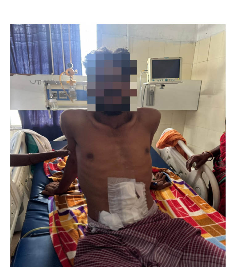 (बीजापुर) जिला चिकित्सालय बीजापुर में जटिल सर्जरी सफल, गंभीर अवस्था में भर्ती युवक को मिला नया जीवन